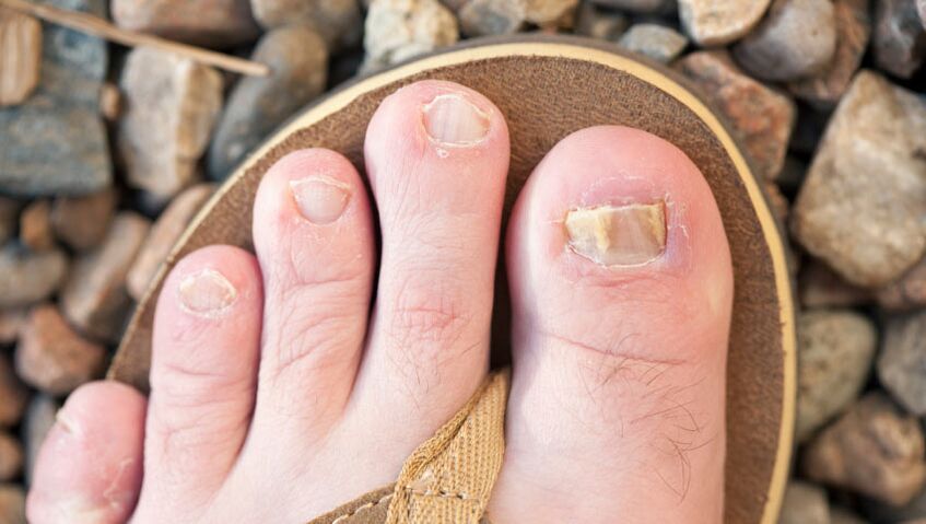cum să tratezi ciuperca unghiilor de la picioare remedii populare picioarele pot răni din cauza ciupercii unghiilor